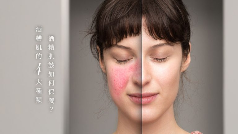 酒糟肌該如何保養？酒糟肌的4大種類